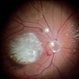 PVD induction with IVTA staining