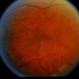 BDR / Macular Edema / Macroaneurysm BDR / Macular Edema / Macroaneurysm