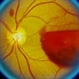Subhyaloid Haemorrhage