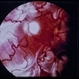 Massive Vitreous Retraction Massive Vitreous Retraction