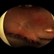 Intraocular Eyelash Intraocular Eyelash