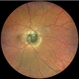 Choroidal Disc Melanoma Choroidal Disc Melanoma