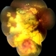 Leber's Miliary Aneurysm Leber's Miliary Aneurysm