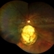 RETINAL DETACHMENT WITH CHOROIDAL COLOBOMA RETINAL DETACHMENT WITH CHOROIDAL COLOBOMA