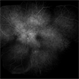 Vogt-Koyanagi-Harada Syndrome