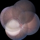 Retinoblastoma Group C Retinoblastoma Group C