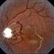 Optic Disc Coloboma Optic Disc Coloboma