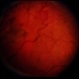 Retinal Capillary Hemangioblastoma Retinal Capillary Hemangioblastoma