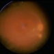 Necrotizing Retinitis Necrotizing Retinitis