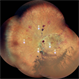 Vitreous Hemorrhage with Sub hyaloid hemorrhage with branch retinal vein occlusion in case of high risk PDR Vitreous Hemorrhage with Sub hyaloid hemorrhage with branch retinal vein occlusion in case of high risk PDR