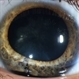 Traumatic Cataract and Iridodialysis, Photo