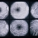 Fundus Albipunctatus Fundus Albipunctatus