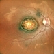 MACULAR COLOBOMA MACULAR COLOBOMA