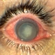 Luxated lens to anterior segment
