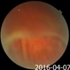 Longstanding Retinal Detachment Due to a Larg Retinal Tear Longstanding Retinal Detachment Due to a Larg Retinal Tear