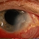 Scleritis Scleritis