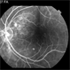 Choroidal Hemangioma Choroidal Hemangioma