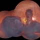 Massive Subretinal Hemorrhage Massive Subretinal Hemorrhage
