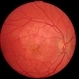 Acute Multifocal Placoid Pigment Epitheliopathy Acute Multifocal Placoid Pigment Epitheliopathy