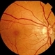 Angioid Streaks Angioid Streaks