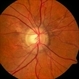Angioid Streaks Angioid Streaks