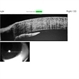 Iridocorneal Angle