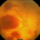 Aggressive Posterior Retinopathy of  Prematurity  with Macular Hemorrhage Aggressive Posterior Retinopathy of  Prematurity  with Macular Hemorrhage