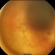 Aggressive Posterior Retinopathy of  Prematurity  with Macular Hemorrhage Aggressive Posterior Retinopathy of  Prematurity  with Macular Hemorrhage