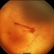 Aggressive Posterior Retinopathy of  Prematurity Aggressive Posterior Retinopathy of  Prematurity