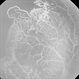 Vascular loops in retinopathy of prematurity