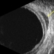 B-scan echography uveal lymphoma with orbital involvement B-scan echography uveal lymphoma with orbital involvement
