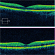 Laser Pointer Injury to Fovea.  Improving Spontaneously Laser Pointer Injury to Fovea.  Improving Spontaneously