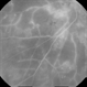 Proliferative Diabetic Retinopathy - Capillary Dropouts Proliferative Diabetic Retinopathy - Capillary Dropouts