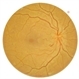 RIGHT EYE- DIABETIC PAPILLOPATHY RIGHT EYE- DIABETIC PAPILLOPATHY