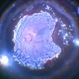 360 Degree Retinectomy 360 Degree Retinectomy