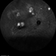 Multifocal Exudative Detachments Due to VKH Multifocal Exudative Detachments Due to VKH