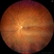 Congenital Retinal Macro Vessel Congenital Retinal Macro Vessel