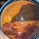 Subhyaloid Hemorrhage Subhyaloid Hemorrhage