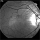 Optic Nerve Pit Related Serous Retinal Detachment