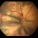 Stage 3 Coats' Disease
