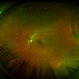 Retinoschisis Left Eye Retinoschisis Left Eye