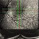 Left Eye Optical Coherence Tomography Showing Optic Disc Pit Left Eye Optical Coherence Tomography Showing Optic Disc Pit