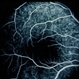 Fenestrated Sheen Macular Dystrophy