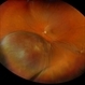 New Choroidal Melanoma with Exudative Detachment New Choroidal Melanoma with Exudative Detachment