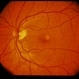 Adult Foveomacular Dystrophy / Pattern Adult Foveomacular Dystrophy / Pattern