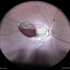 SUBHYALOID HEMORRHAGE IN A CASE OF VALSALVA RETINOPATHY
