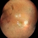 Horseshoe Tear in Retinitis Pigmentosa Horseshoe Tear in Retinitis Pigmentosa