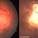 Optic Disc Granuloma Optic Disc Granuloma