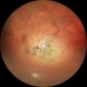 Central Retinal Artery Occlusion-Widefield Central Retinal Artery Occlusion-Widefield