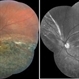 Spontaneous Reattachment of Retinal Detachment Spontaneous Reattachment of Retinal Detachment